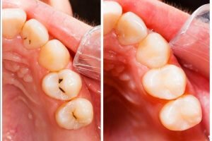 caries